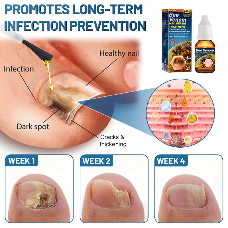 Bee Venom Nail Repair Treatment
