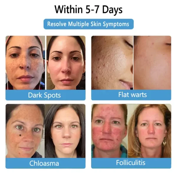 𝐓𝐎𝐃𝐀𝐇𝐎𝐅™ 𝑩𝒆𝒆 𝑽𝒆𝒏𝒐𝒎 𝑴𝒖𝒍𝒕𝒊-𝑺𝒚𝒎𝒑𝒕𝒐𝒎 𝑻𝒓𝒆𝒂𝒕𝒎𝒆𝒏𝒕 𝑪𝒓𝒆𝒂𝒎