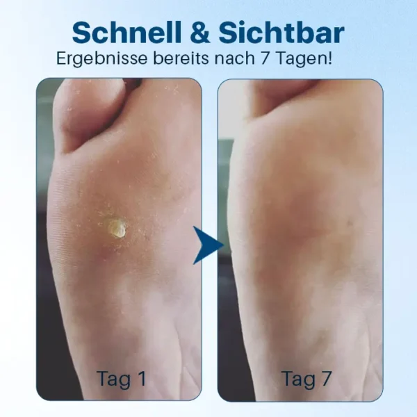 Biancat™ FußGlow Pro-Stärke Hornhaut- und Schwielenentferner-Gel