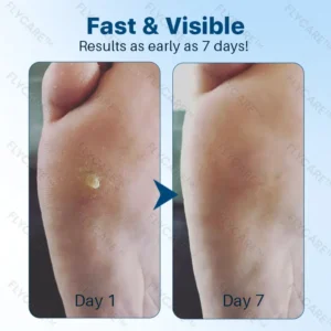 FLYCARE™ FootGlow Pro-Strength Corn & Callus Remover Gel