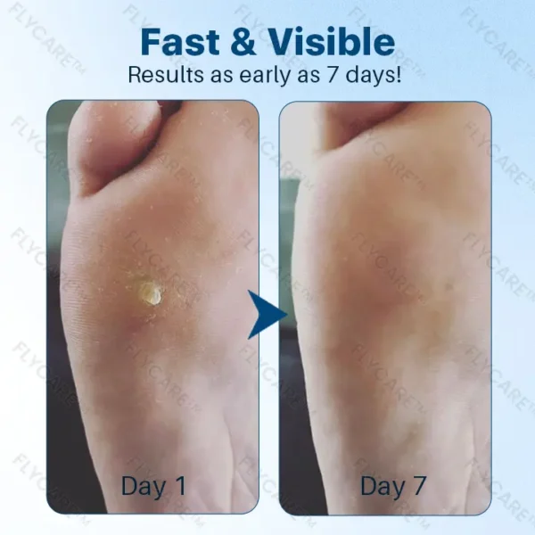 FLYCARE™ FootGlow Pro-Strength Corn & Callus Remover Gel