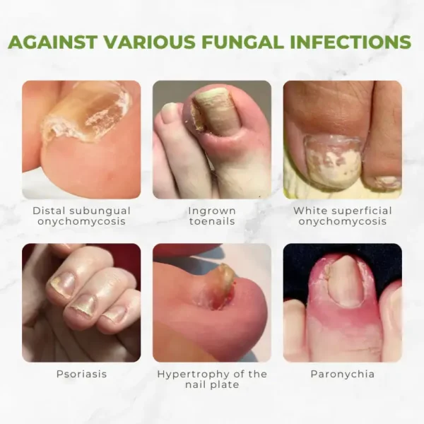 Flycare™ FungiVanish Bee Venom Nail Treatment Oil
