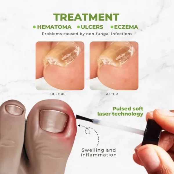 Flycare™ FungiVanish Bee Venom Nail Treatment Oil