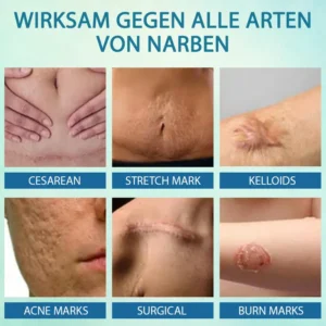 ScarEase™ Fortgeschrittenes Hautheilungsgel