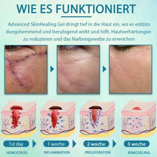 ScarEase™ Fortgeschrittenes Hautheilungsgel