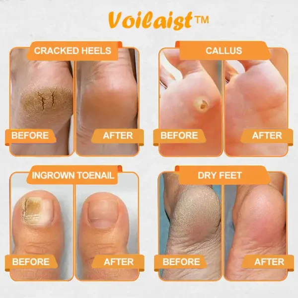 Voilaist™ Bee Venom Lymphatic Drainage & Slimming Foot SoakBeads