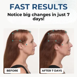 Special Discount HairGenix™ Hair Regrowth Capsules