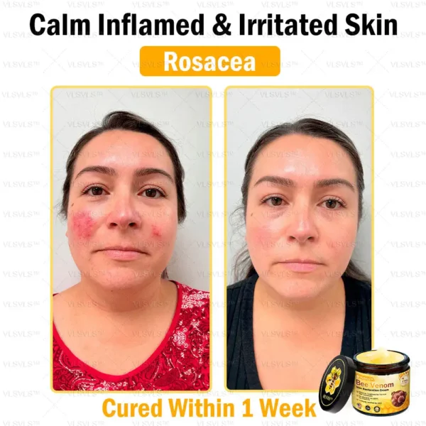 Special Sale VLSVLS™ Bee Venom Skin Restoration Cream