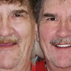 HZA™ Advanced Customized Full Denture Set