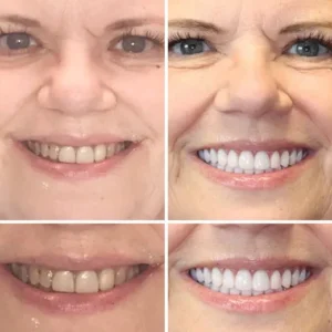 HZA™ Advanced Customized Full Denture Set