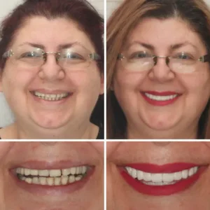 HZA™ Advanced Customized Full Denture Set