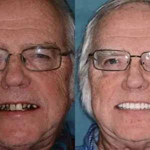 HZA™ Advanced Customized Full Denture Set