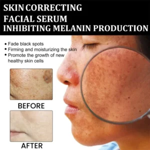 2025s,NESLEMY™ Fast Dark Spot Remover ✨ Where science meets luxury. Our melanin-correcting serum erase