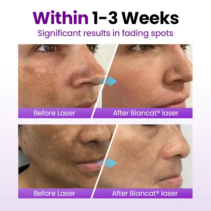 Biancat® SpotErase Probiotic Shield Serum (A)