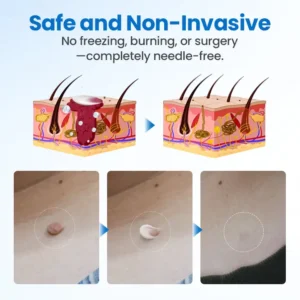 Timilk® TagGone Wart Removal Cream (A)