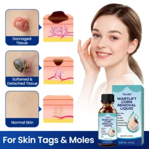 Timilk® WartLift Corn Removal Liquid (A)