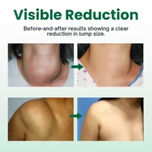 Cvreoz® Knot-X Lipoma Dissolve Cream