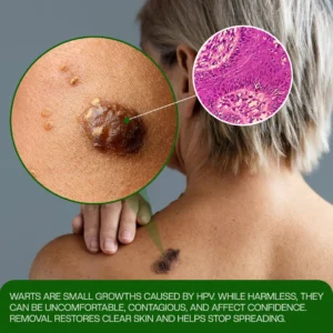 Timilk® ClinixClear Wart Remover Patch-