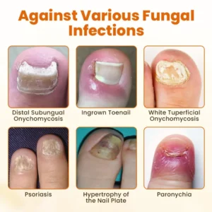 Timilk® FungiBee Advanced Nail Repair Spray❤️‍🔥